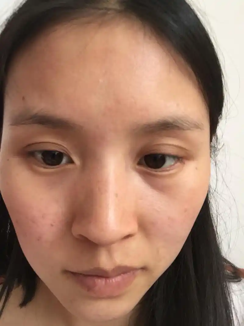 肌肤暗沉美白变黑皮,这是什么原因,选择医美还是选择护理?