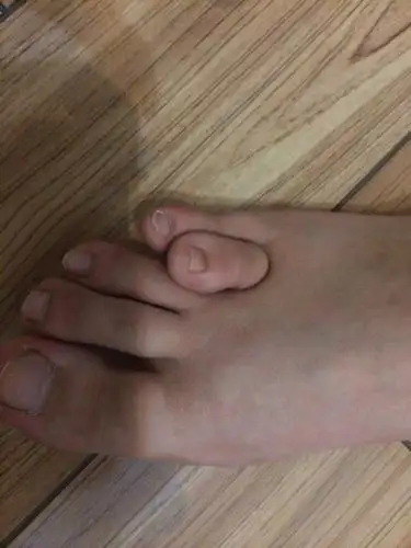 2014-07-04 梁淑梅 医师 脚趾头奇形那里能治疗,我女儿生时和别的