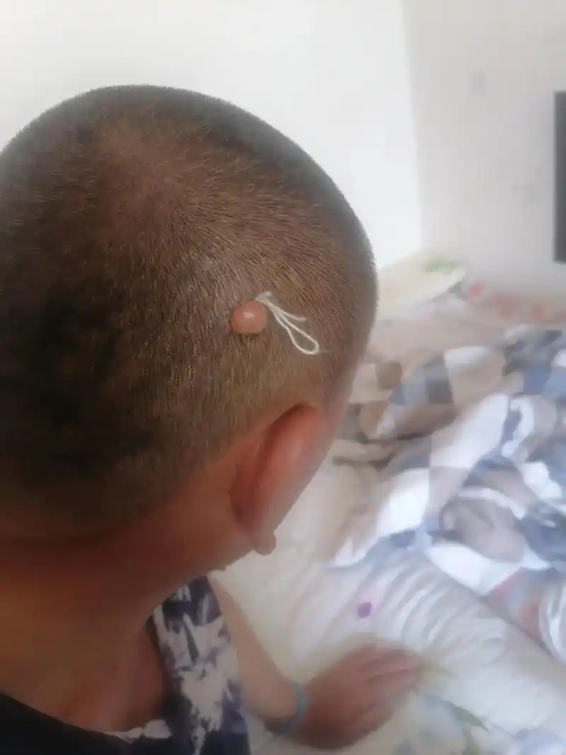 盘踞在头顶五十年的大瘊子,在疫情闲暇之余,从5月3号开始,用 - 抖音