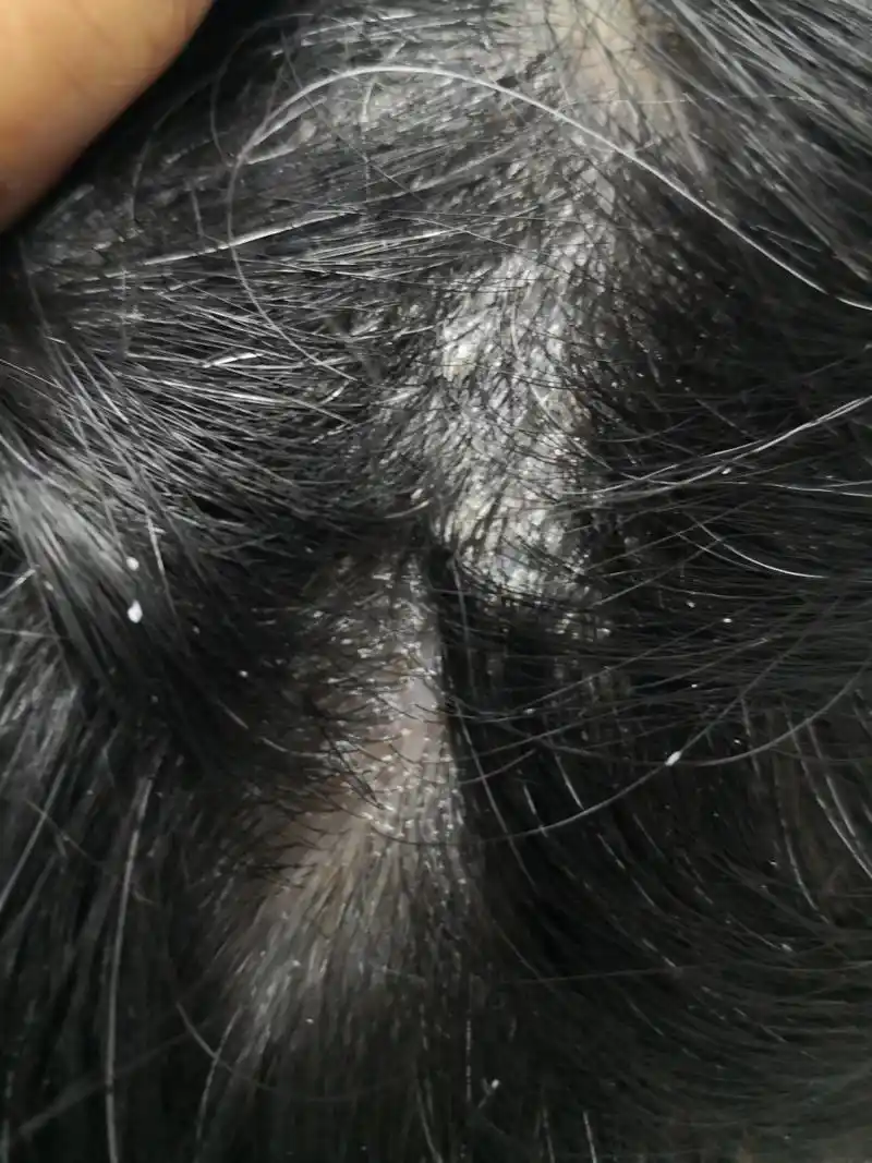 脂溢性皮炎# 可以使用药物治疗能够很快达到好的治疗效果.