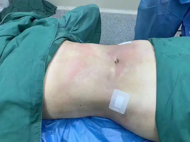 腰腹环吸术后即刻对比