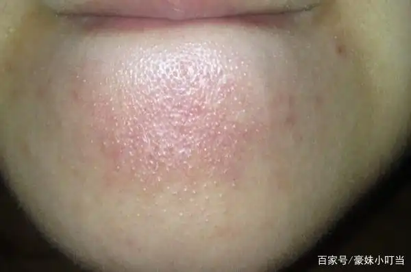 亲测!真正的祛闭口神器是它们