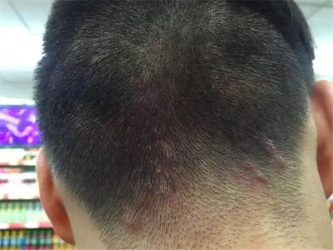 男童头皮毛囊炎康复图片_有来医生