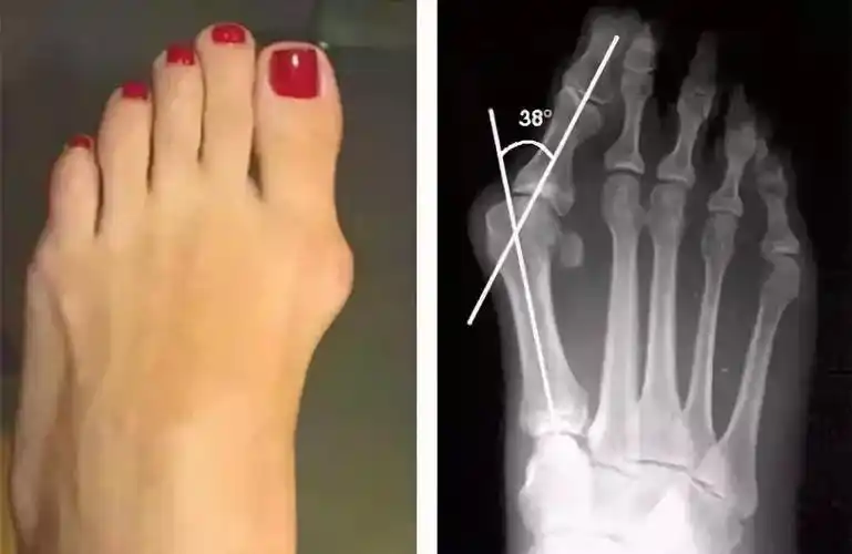 拇外翻的保守治疗