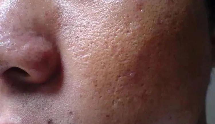 护肤品无法很好穿透角质层渗透到肌肤深处,所以在皮肤表面凝结,再经过