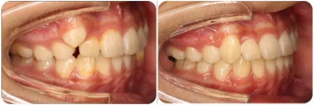 尖牙vs虎牙 这次我pick这颗长得壮又能吃的牙_儿童牙病_疾病介绍_相关