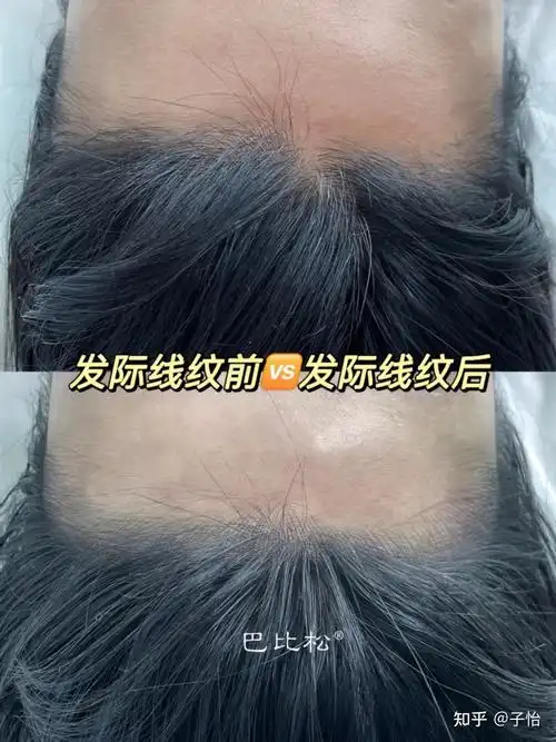 发际线高是什么体验发际线太高怎么办