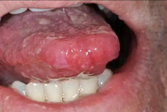 一期梅毒(又称硬下营):典型的梅毒表现为生殖器不痛不痒的皮肤溃疡.