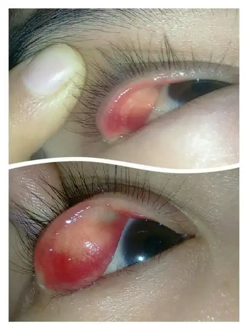 我怀孕将近5个月了,图中是我孕两个月的时候起的麦粒肿,第一张图片是