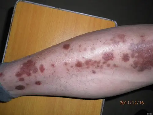 【病例讨论】双下肢红斑 [病例帖]