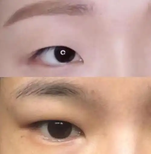 假性上睑下垂教你判断你是否眼睑下垂_上睑下垂_上睑下垂症状表现 -