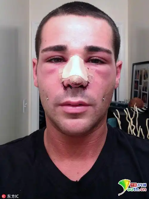 美国男子整容百次屁股植入硅胶变超级臀