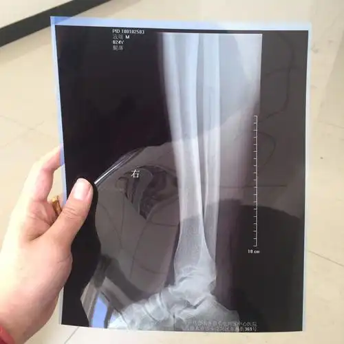 脚崴了 这是片子 大家帮看看 腓骨是不是有裂纹 踝关节有问题吗