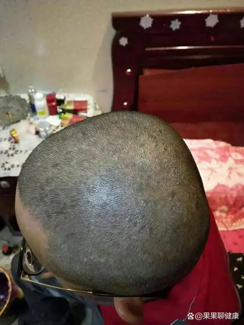 头上牛皮癣真的很痛苦,还好不困扰了