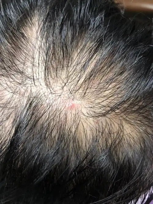 这里的头皮毛囊炎,主要是头皮毛囊因为被细菌,真菌,病毒或蠕形螨感染