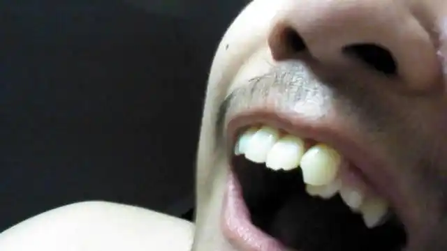 尖牙把侧切牙的位置占了,侧切牙长在尖牙后面,这算阻生牙吗