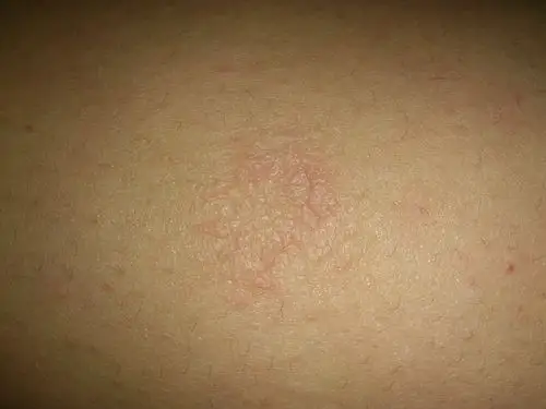 大腿上长了一个癣.不知道是什么,有脱皮迹象