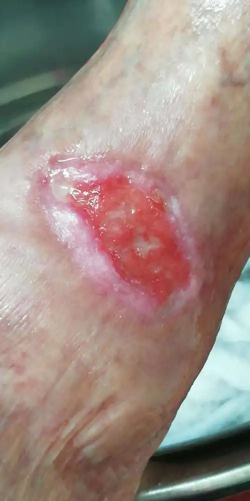 踝前皮肤溃疡 - 好大夫在线