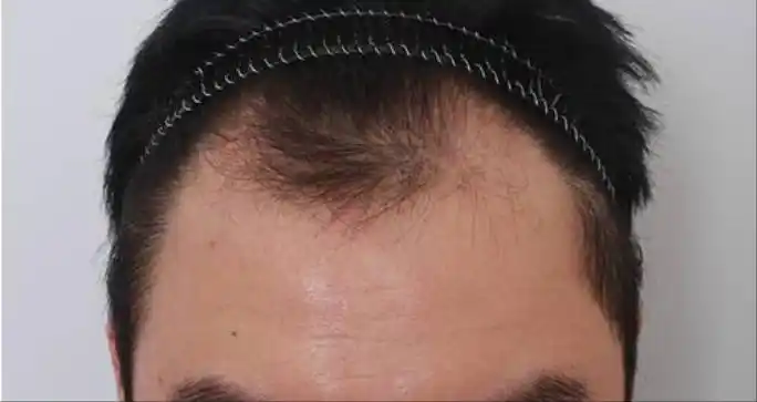 m型脱发能自己恢复吗?到底该怎么改善?荆州主任医师来解惑