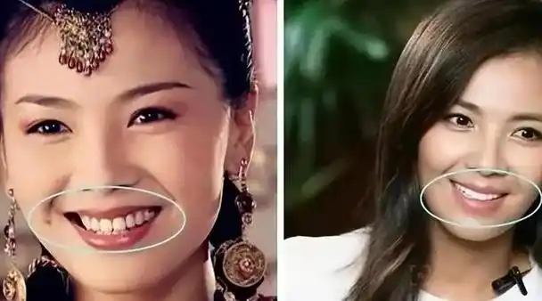 明星整牙术中的"烤瓷牙"究竟有多令人惊悚呢?