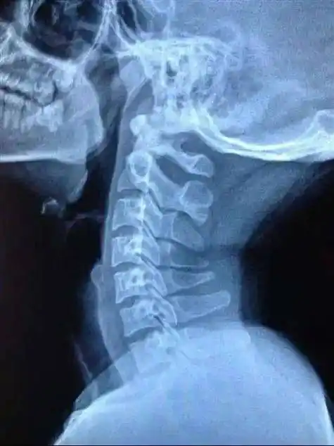 生理曲度变直 学习,补课,网课,同时户外运动减少,孩子脖子经常向前倾