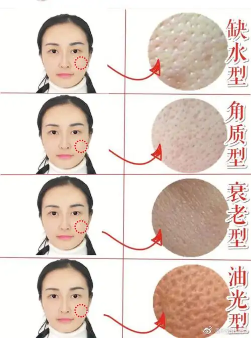 不同类型的毛孔粗大具体表现的特征都有哪些怎么做才能正确的缩小