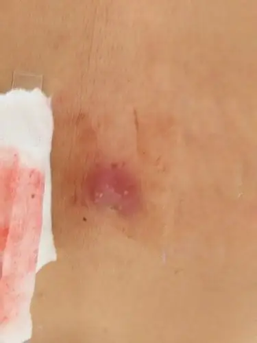 我爸爸背上长了个疮,医院说是毛囊炎,可十多天了