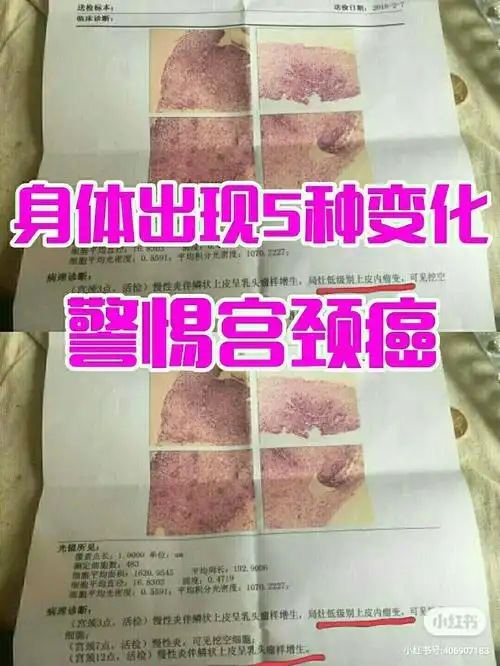 身体有5个变化,或是宫颈癌前兆,别忽视!