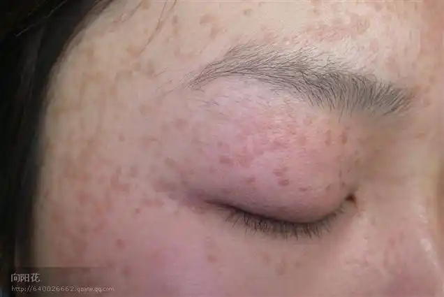 【引用】常见皮肤病