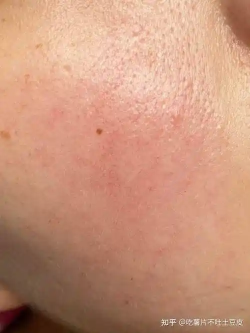 脸上有红血丝怎么办 面部红血丝怎么保养和去除