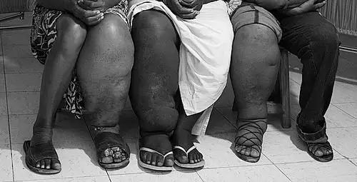 作为一种被忽视的热带疾病,象皮病曾给患者带来巨大痛苦.