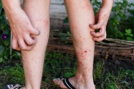 腿部瘙痒男子抓痒用手,腿,瘙痒,医疗保健和医学的概念照片