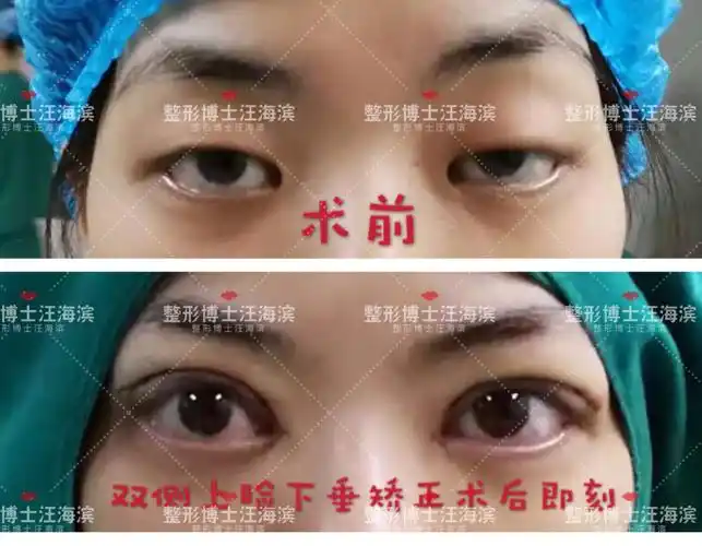 双侧上睑下垂矫正术后即刻 - 好大夫在线