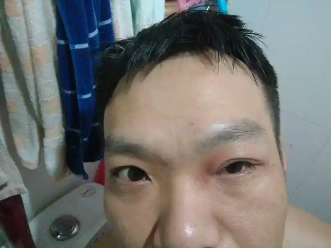 眼皮肿了,还疼,感觉里面有东西磨着,两天了,平时喝