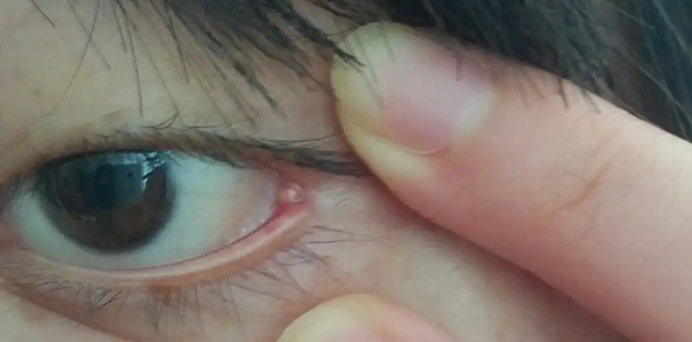 左眼角内部长了个东西,不痛不痒,就是眨眼睛有点不舒服,有东西搁着的