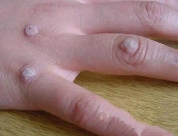 假尖锐湿疣白醋测试图片_有来医生