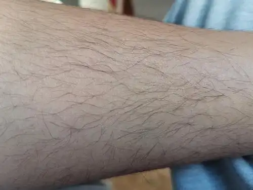 啊姐妹们体毛太重怎么办25更新辣去医院取到了激素六项的结果