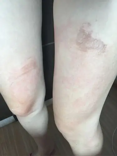 不小心将稀饭洒腿上了烫了泡怎么处理