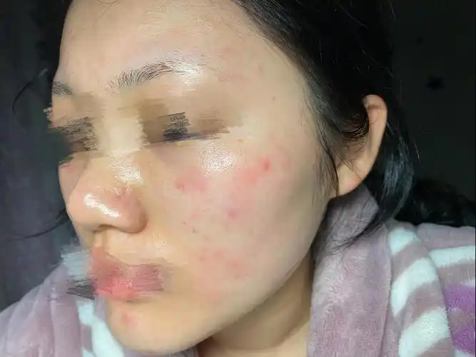 连续用露得清a醇一个星期屏障受损严重有图慎入请姐妹们帮忙更新皮肤