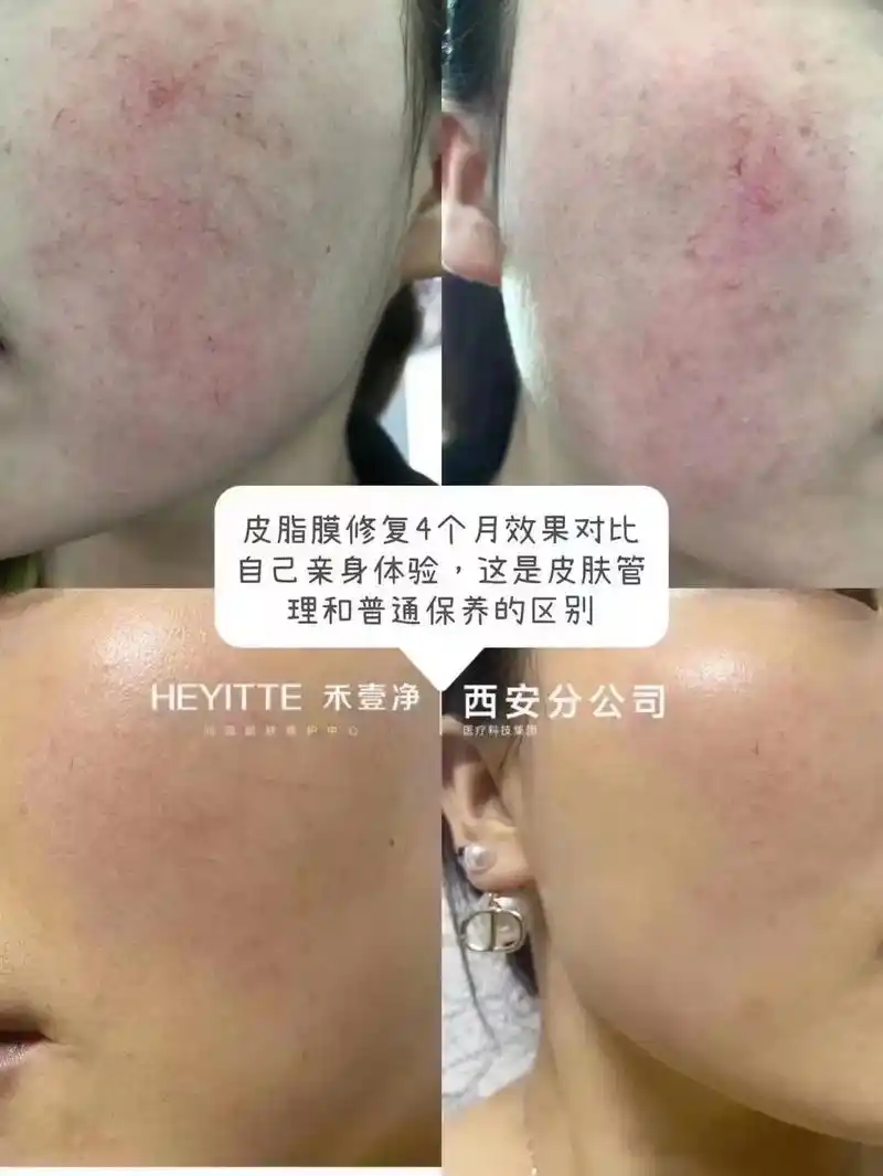 皮脂膜修复#问题性皮肤 - 抖音