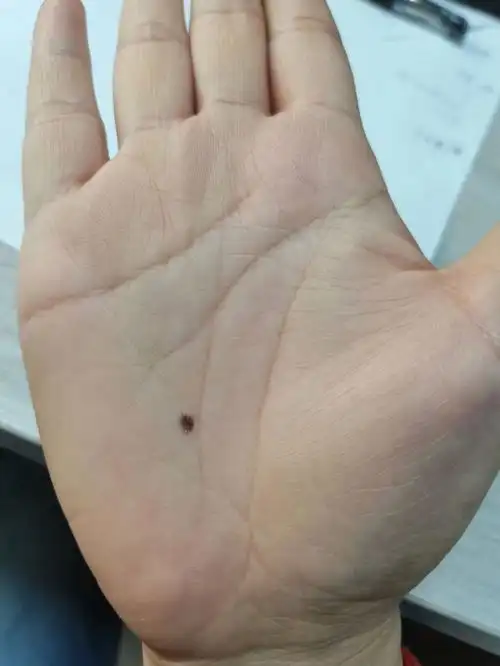 听说掌心痣是上辈子留的记号