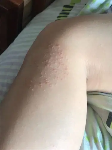 孩子身上起了一堆不疼不痒的疹子