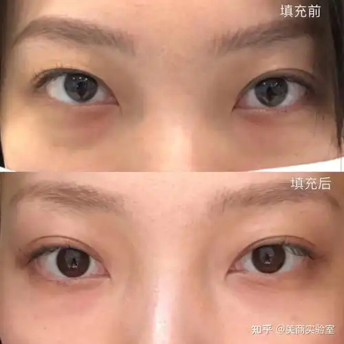 答:眼眶凹陷又分为上睑凹陷和眼下凹陷(俗称泪沟)眼窝凹陷是指上睑区