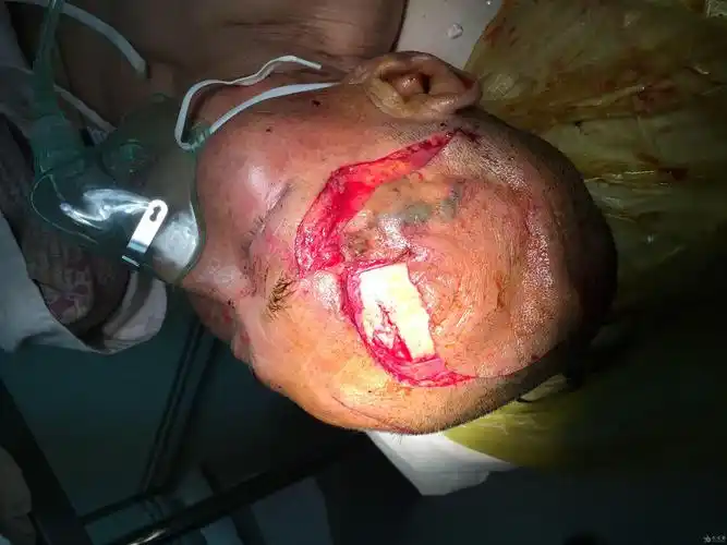 颅脑损伤分享一例严重头皮撕脱伤病例原创