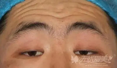 如重症肌无力,脑血管病变等引起的上睑下垂,千万