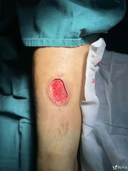 虫咬伤后皮肤坏死小腿植皮1例