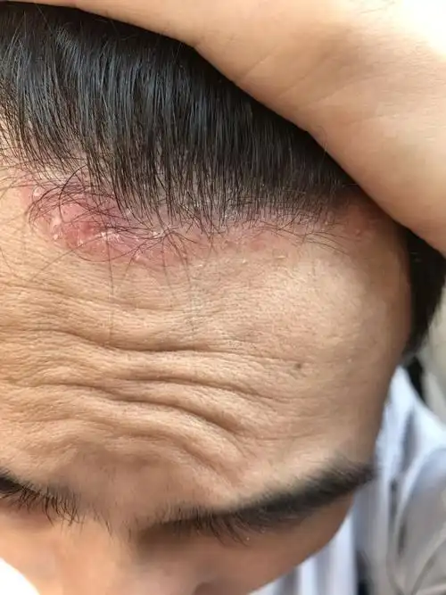 头皮问题 瘙痒掉屑