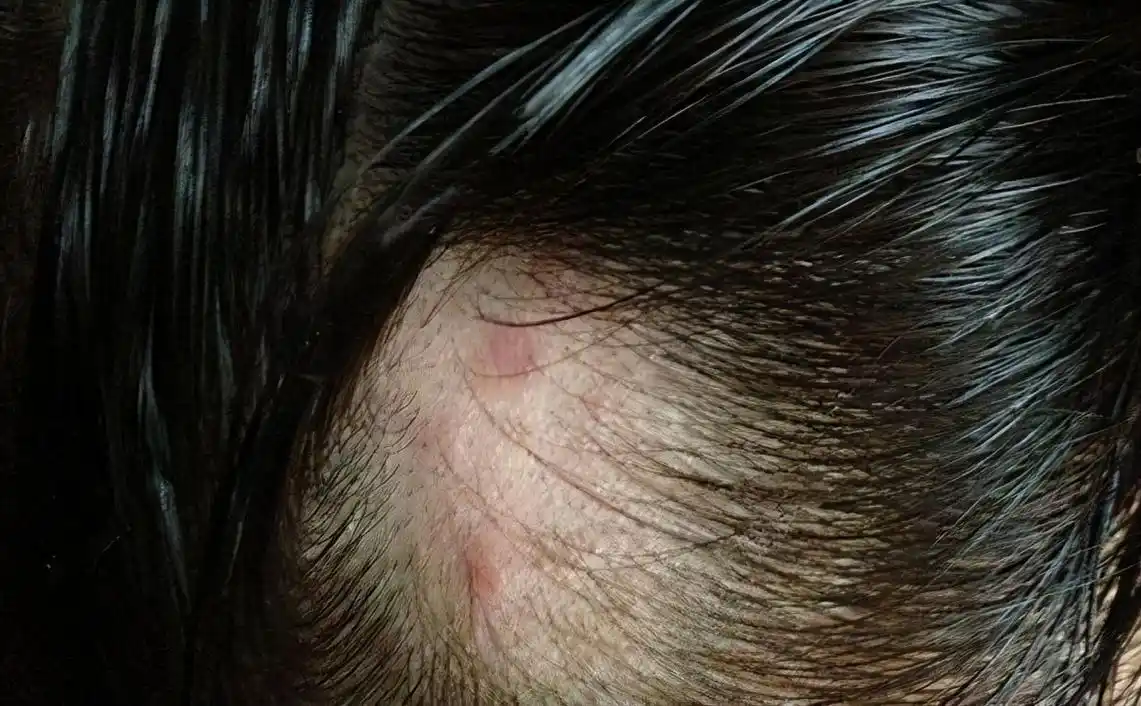 头皮发痒时,一抓发现有"疙瘩",是怎么回事?听听医生怎么说