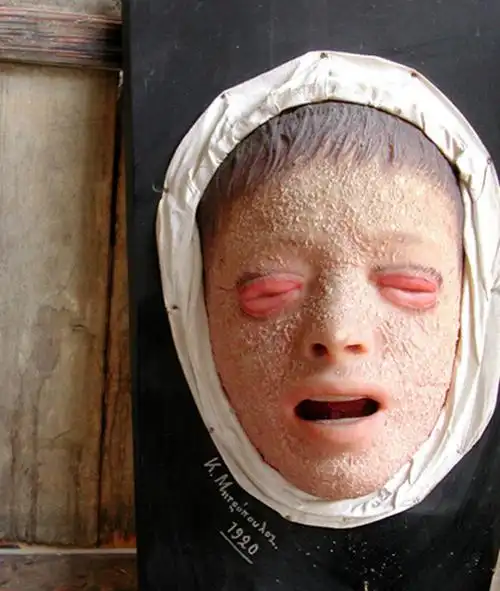 小男孩脸上有鱼鳞病的图片