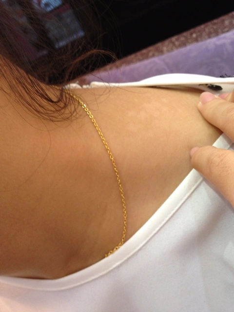 [小夫妻]脖子长了花斑癣